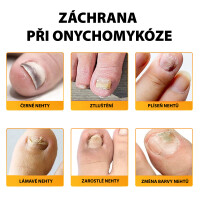 Wellife Náplasti na nehtovou mykózu 32 ks