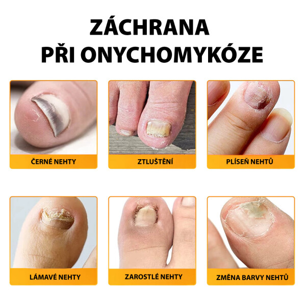 naplasti_na_nehtovou_mykozu_pouziti1.jpg